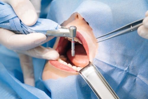 poser un implant après extraction de dent