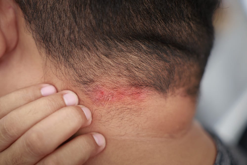 Comment est posé le diagnostic de dermatite atopique