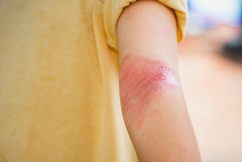 Comprendre la dermatite atopique