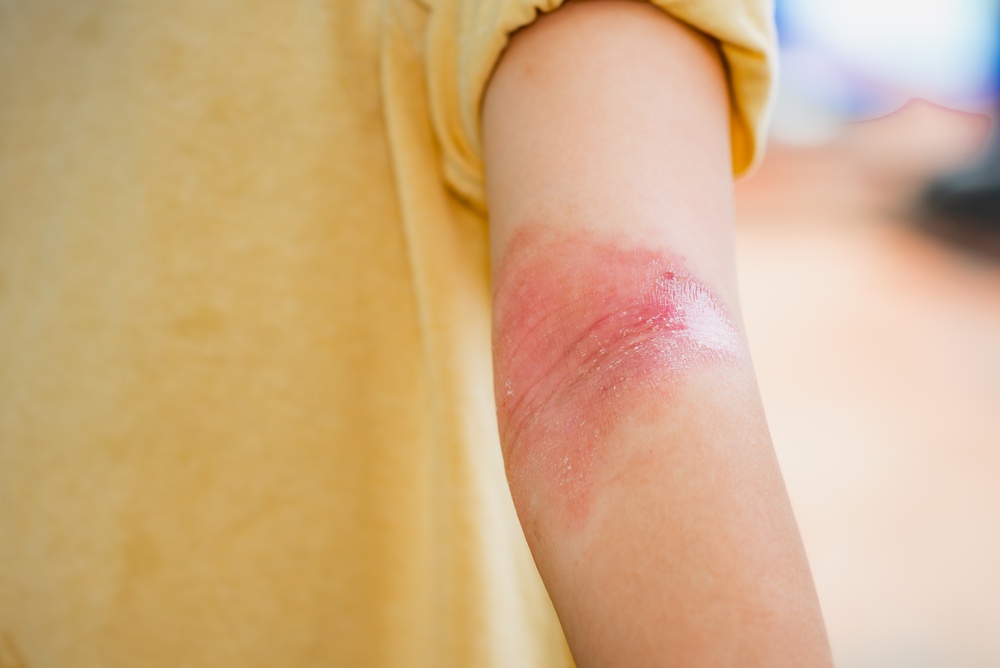 Comprendre la dermatite atopique