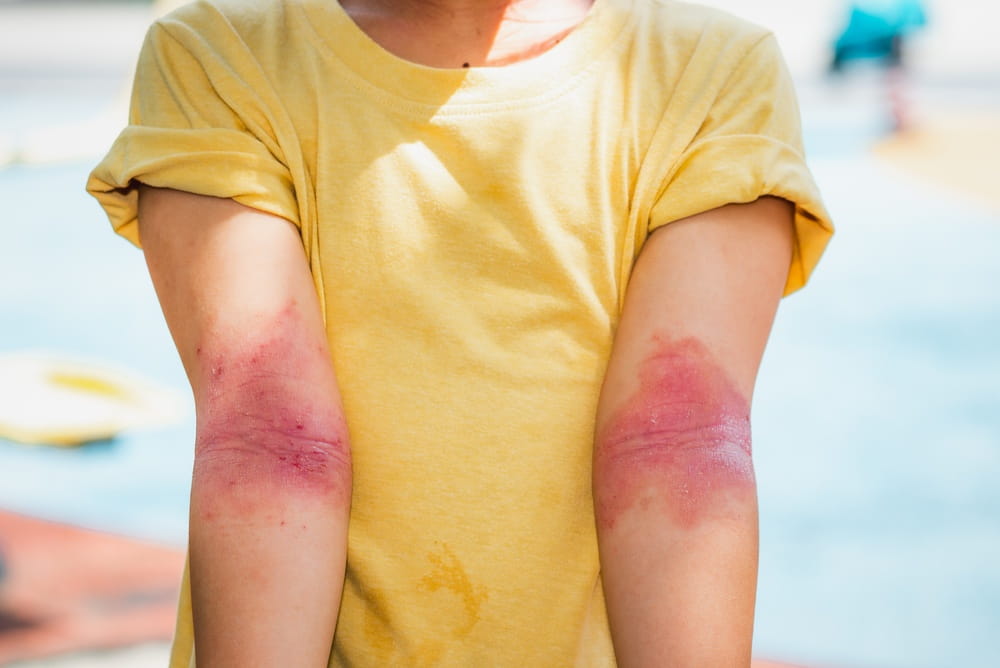 Prévention et qualité de vie avec une dermatite atopique